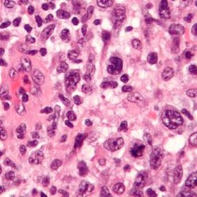 Microgram of anaplastic large cell lymphoma.