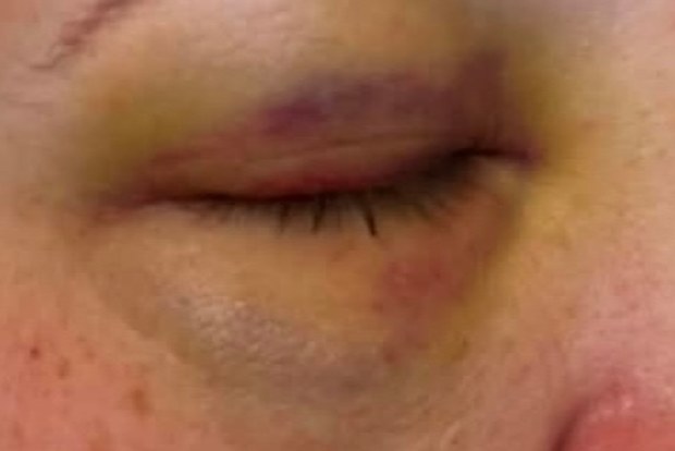 A youth detention worker suffered a black eye, allegedly in an assault by an imate.
