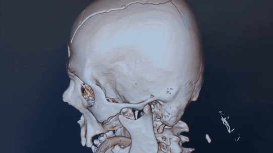 A CT Scan showing a gunshot wound in a skull.