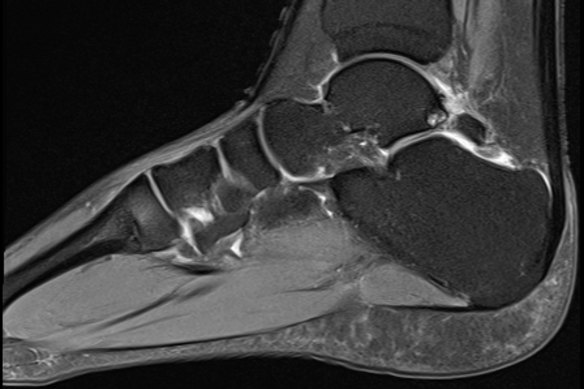 An MRI scan of a ballet dancer’s ankle.