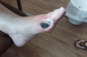 The infected pressure sore on Mrs Taouk’s foot on January 10. Two weeks after this photo the grandmother died.