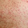 Three confirmed measles cases in Brisbane, Gold Coast and Sunshine Coast