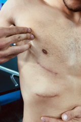 The surgery scars from Jai Opetai's rib injury.