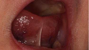 Tongue Tie Surgery Experts Caution Against Unnecessary Surgery