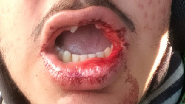 A Menulog rider lost several teeth after he was allegedly assaulted in Randwick last month by a stranger shouting racial epithets.