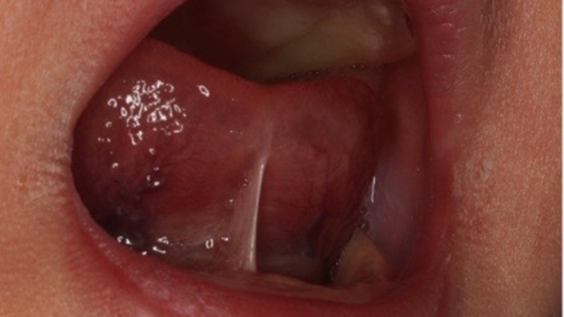 Tongue Tie Surgery Experts Caution Against Unnecessary Surgery