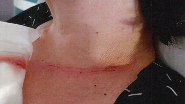 The woman's neck injury. 