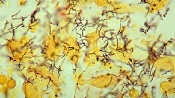 There has been a rise in syphilis cases in Victoria.