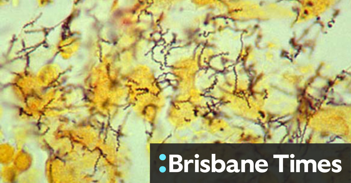 Syphilis epidemic in Melbourne suburbs: scientists use genomic sequencing to track STD - Vimarsana News