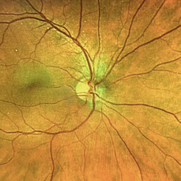The human retina: End product of millions of years of evolution.