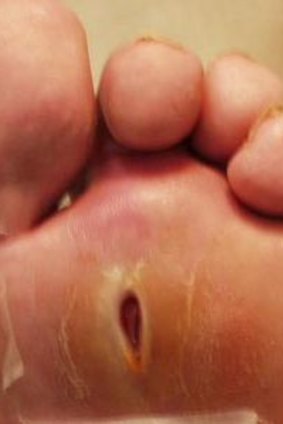 A diabetic ulcer on a patient's foot.