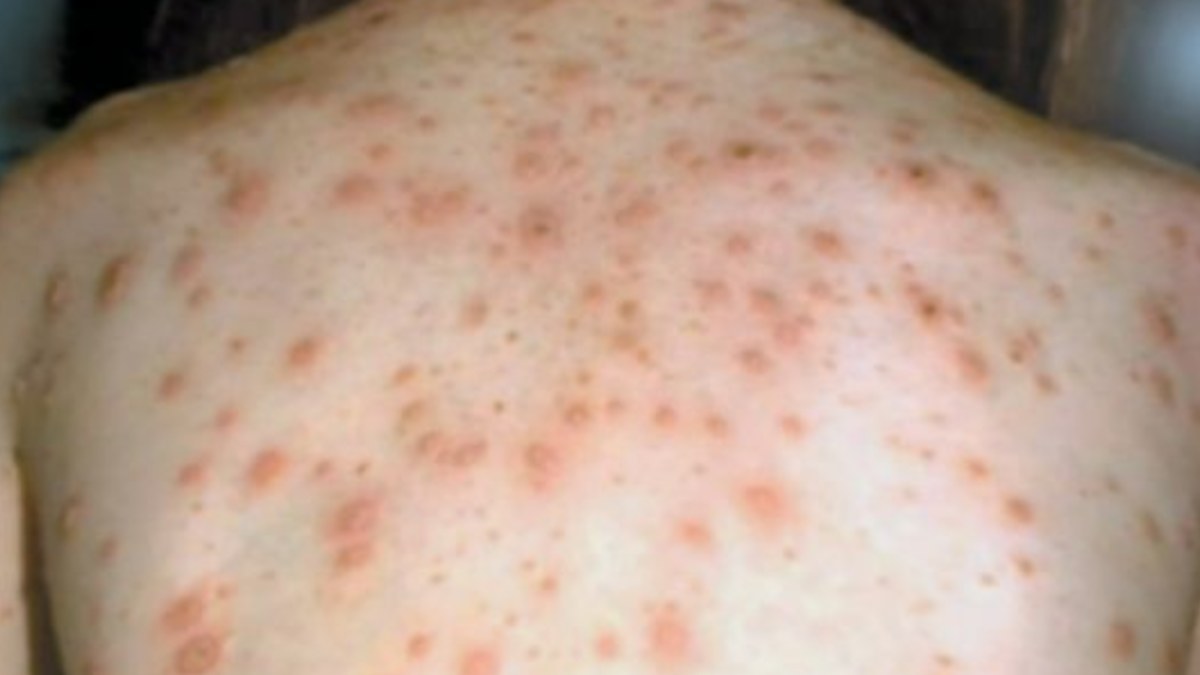 Measles warning for Sydney after infected patient visits numerous spots includin...