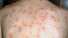 Symptoms of measles include a general fever, sore eyes and a cough that is followed a few days later by a blotchy rash that spreads from the head and neck to the rest of your body.