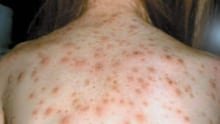 Symptoms of measles include a general fever, sore eyes and a cough that is followed a few days later by a blotchy rash that spreads from the head and neck to the rest of your body.