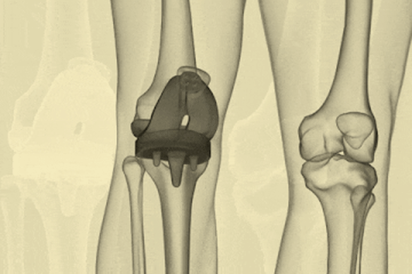 A knee replacement.