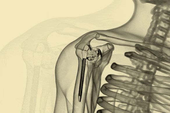 A shoulder replacement.