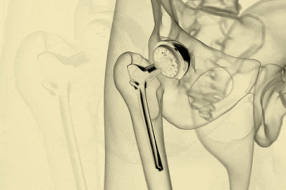 A hip replacement.
