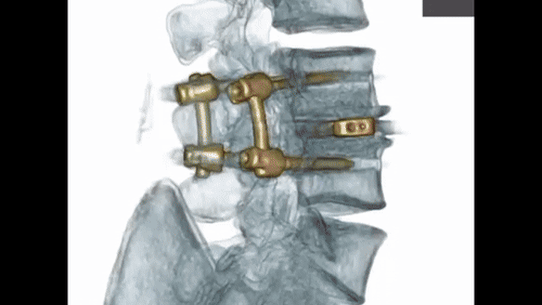 Blicavs spent more than 12 months doing rehabilitation.