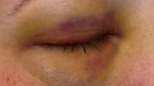 A youth detention worker suffered a black eye, allegedly in an assault by an imate.
