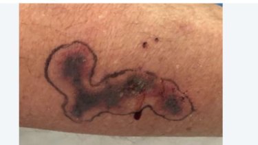 NSW Fire and Service deputy commisioner Malcolm Connellan posted an image of his snake bite wounds on LinkedIn