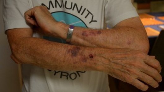  Jim Beatson shows damage to his arms caused during an incident with Premier Gladys Berejiklian’s security staff. 