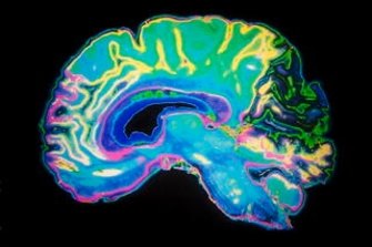 Coloured MRI scan of a human brain.