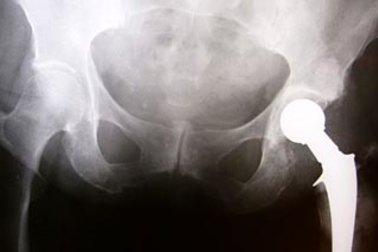 Hip replacement gap fees can vary for many reasons such as the complexity of the surgery.