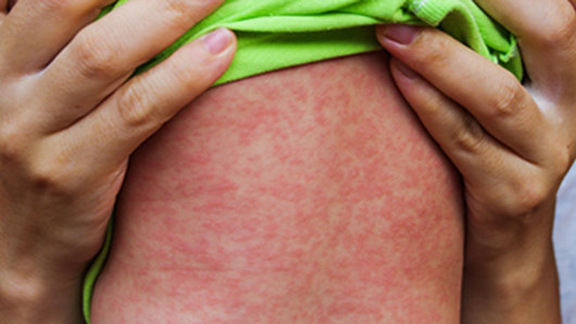 Measles causes fever, cough and a runny nose, then a red spotty rash and sore eyes.