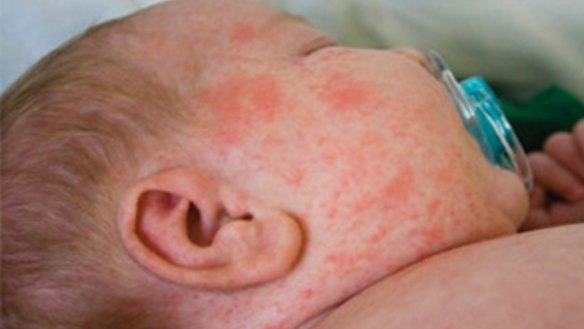 The infant was too young to be vaccinated against measles.