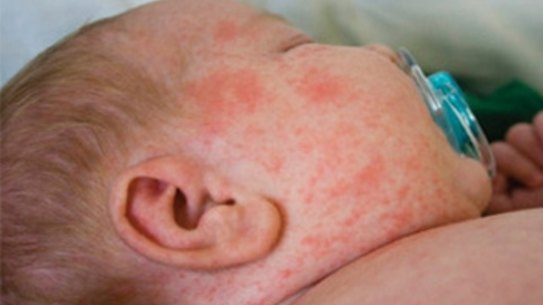 Passengers on a flight from Bali to Australia have been warned to look out for symptoms of measles after a co-passenger was diagnosed on Sunday. 