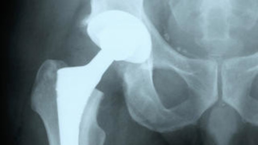 Obese hip replacement patients are more resource intensive for hospitals, researchers say.