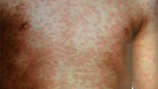 Measles symptoms include a red, blotchy rash spreading from the head and neck to the rest of the body.