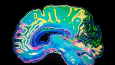 Coloured MRI scan of a human brain.