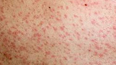 Last year was a horror year for measles in Queensland and health authorities hope to avoid a repeat.