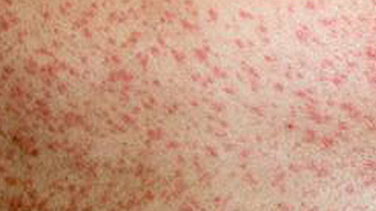 Health authorities have issued another measles alert. 
