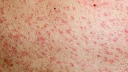  Measles can be easily spread from person to person.