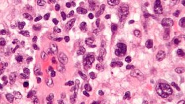 Microgram of anaplastic large cell lymphoma.