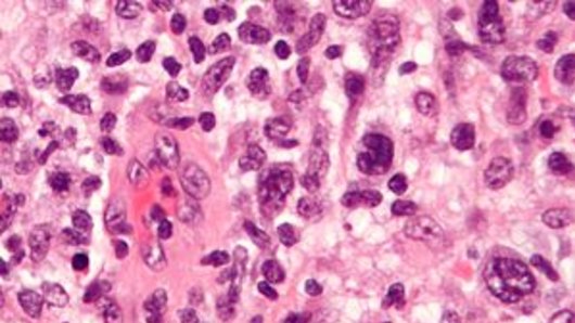 Microgram of anaplastic large cell lymphoma.
