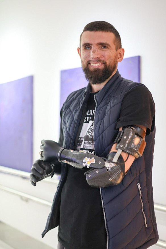 Former soldier Zakhar Biryukov has a mechanical right leg, an artificial right eye and two robotic arms. 