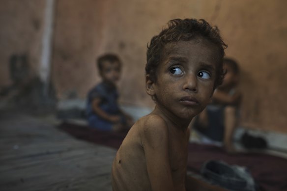Malnourished Yazan Abu Ful, 2, sits at his family home in the Shati refugee camp in Gaza City.