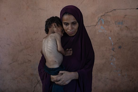 Palestinian child Yazan Abu Foul, 2, who is suffering from severe malnutrition, is held by his mother, Naima.