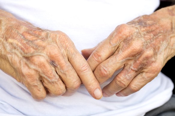 Swollen knuckles can be a sign of arthritis. For effective treatment, a diagnosis is vital.