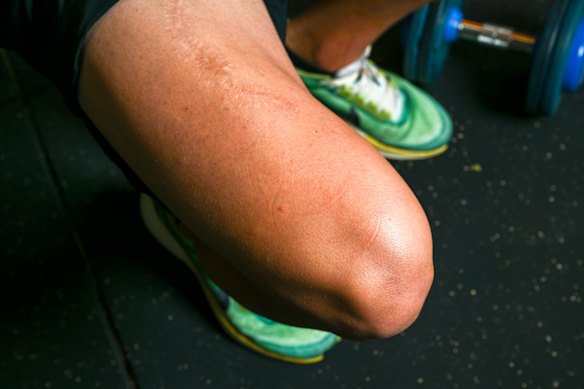 Robey’s scar from a mountain bike accident five years ago.