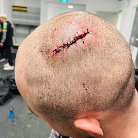 GRAPHIC CONTENT: Dylan Edwards required ten stitches for a nasty gash on his head.