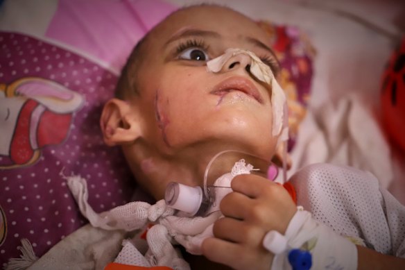Three-year-old Amr al-Hams has brain damage caused by an Israeli strike on his family’s tent in April.