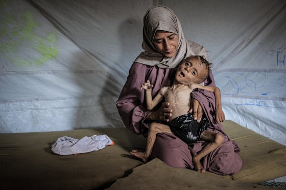 Muhammad Zakariya Ayyoub al-Matouq, 1, is facing life-threatening malnutrition. Having dropped from nine to six kilograms, he struggles to survive in a tent in Gaza City, where milk, food, and other basic necessities are lacking.