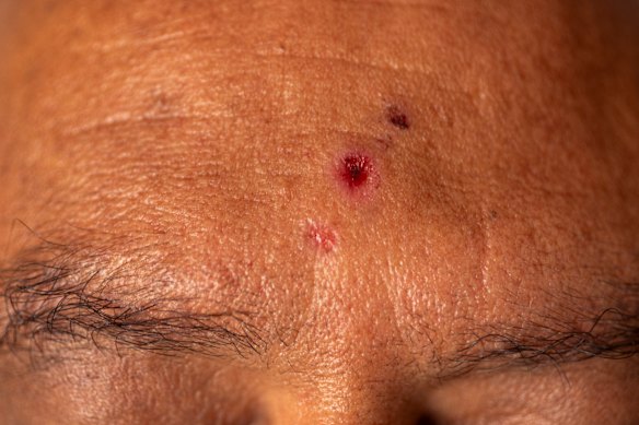 The three wounds on Bhupi’s head have since been filled with glue.