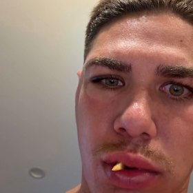 Reece Walsh posted a photo of his fractured cheekbone on Instagram.