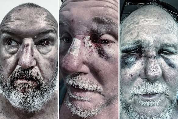 Images from the Public Service Association NSW showing injuries sustained by one of the guards.
