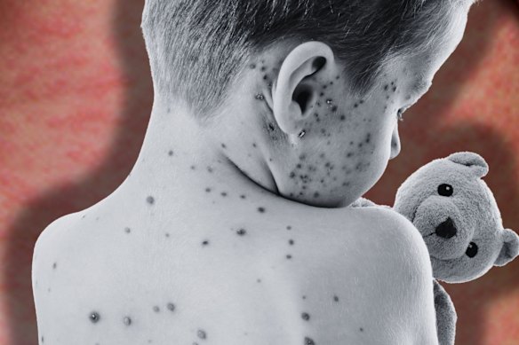 The number of US children catching measles is rising. 